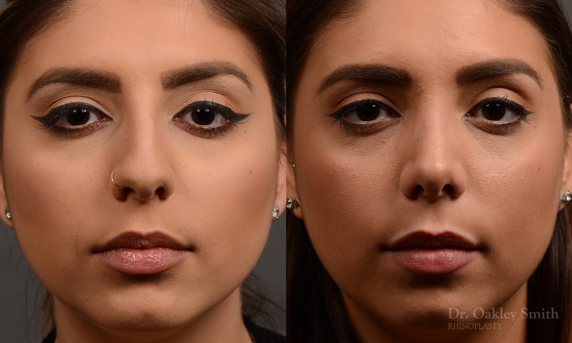 rhinoplasty Nothing demonstrates the skillful craftsmanship that Dr. Oakley Smith accomplishes during his surgeries than a collection of before and after case studies. As one of a hand full of surgeons in North America who limits his practice to only Rhinoplasty surgery, it is obvious that he has mastered his art. There is no question why he is one of the busiest cosmetic nose job surgeons in the country.