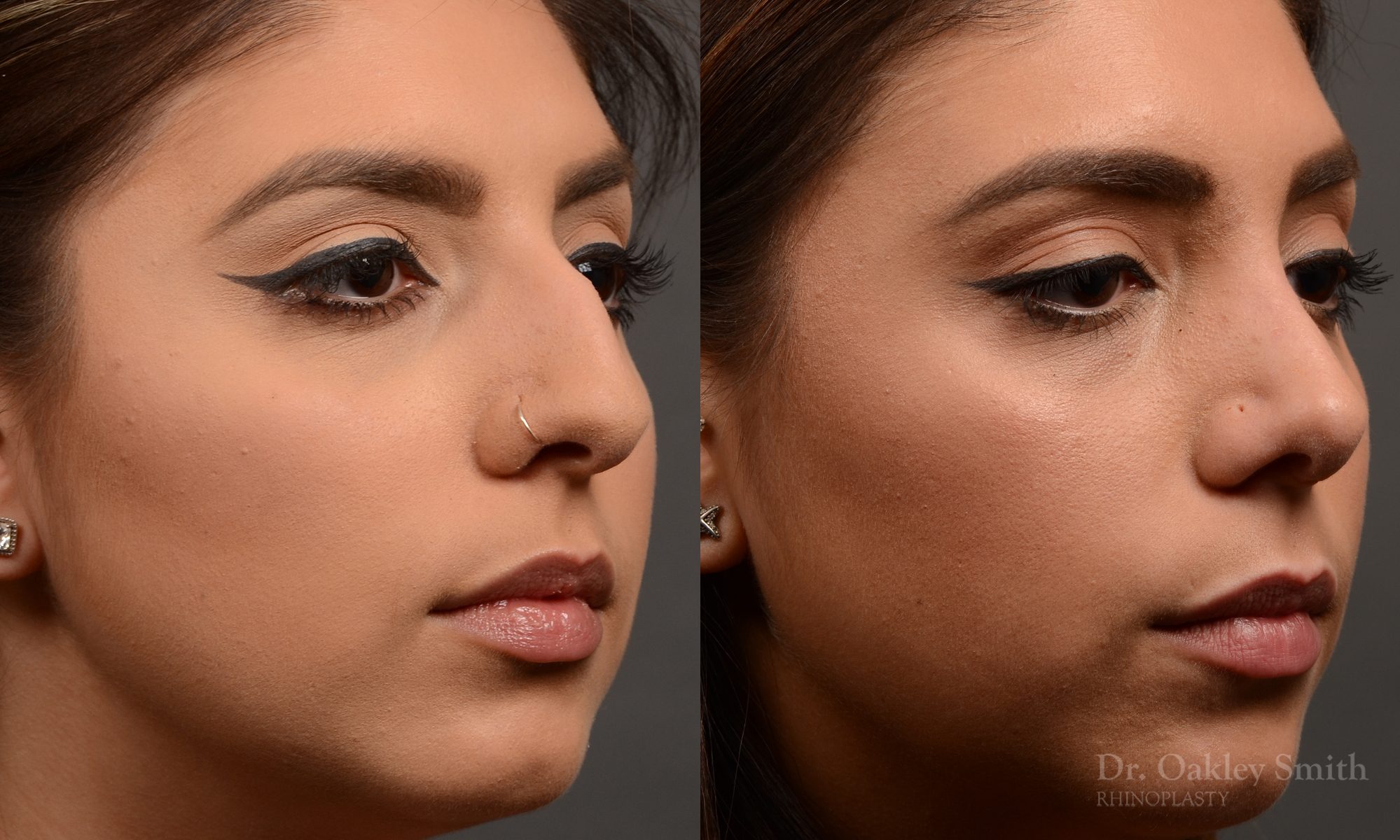 rhinoplasty Nothing demonstrates the skillful craftsmanship that Dr. Oakley Smith accomplishes during his surgeries than a collection of before and after case studies. As one of a hand full of surgeons in North America who limits his practice to only Rhinoplasty surgery, it is obvious that he has mastered his art. There is no question why he is one of the busiest cosmetic nose job surgeons in the country.
