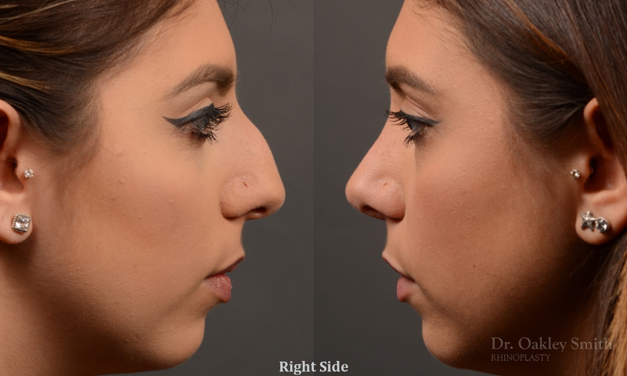rhinoplasty Nothing demonstrates the skillful craftsmanship that Dr. Oakley Smith accomplishes during his surgeries than a collection of before and after case studies. As one of a hand full of surgeons in North America who limits his practice to only Rhinoplasty surgery, it is obvious that he has mastered his art. There is no question why he is one of the busiest cosmetic nose job surgeons in the country.