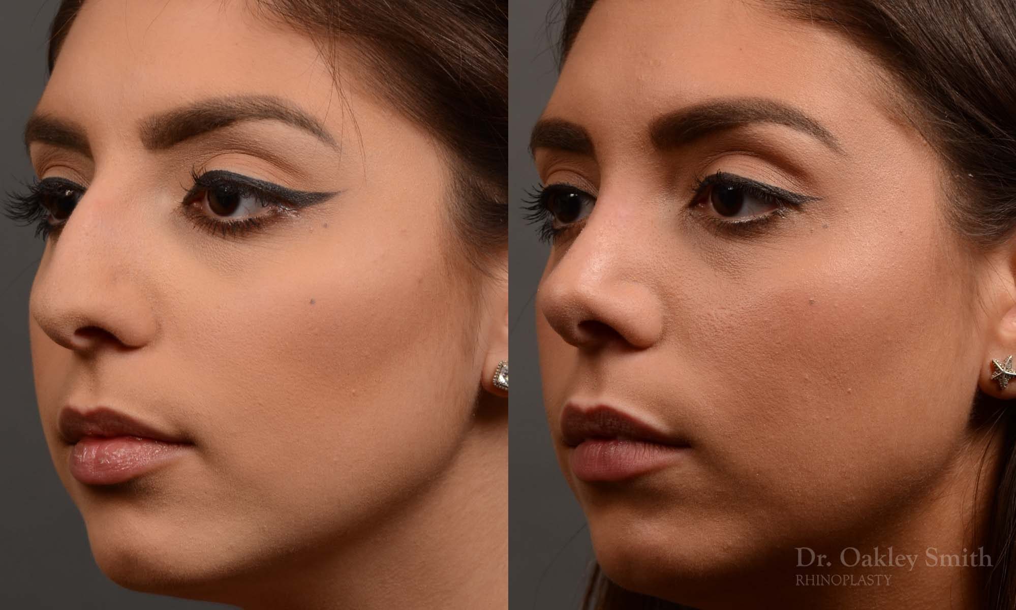 rhinoplasty Nothing demonstrates the skillful craftsmanship that Dr. Oakley Smith accomplishes during his surgeries than a collection of before and after case studies. As one of a hand full of surgeons in North America who limits his practice to only Rhinoplasty surgery, it is obvious that he has mastered his art. There is no question why he is one of the busiest cosmetic nose job surgeons in the country.