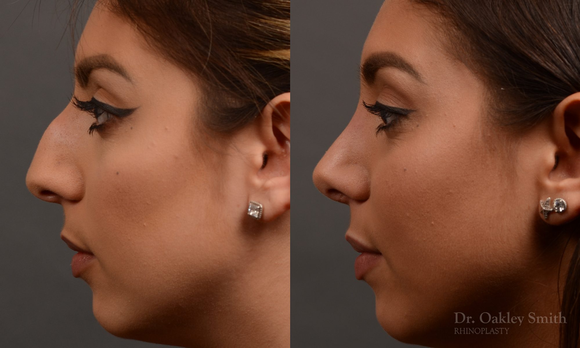 rhinoplasty Nothing demonstrates the skillful craftsmanship that Dr. Oakley Smith accomplishes during his surgeries than a collection of before and after case studies. As one of a hand full of surgeons in North America who limits his practice to only Rhinoplasty surgery, it is obvious that he has mastered his art. There is no question why he is one of the busiest cosmetic nose job surgeons in the country.