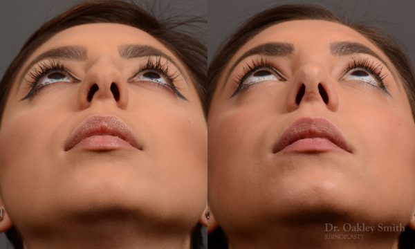 rhinoplasty Nothing demonstrates the skillful craftsmanship that Dr. Oakley Smith accomplishes during his surgeries than a collection of before and after case studies. As one of a hand full of surgeons in North America who limits his practice to only Rhinoplasty surgery, it is obvious that he has mastered his art. There is no question why he is one of the busiest cosmetic nose job surgeons in the country.