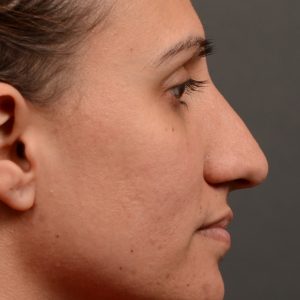 rhinoplasty to create a more feminine nose