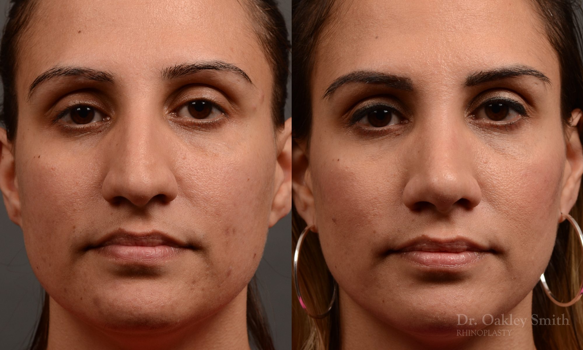 rhinoplasty Nothing demonstrates the skillful craftsmanship that Dr. Oakley Smith accomplishes during his surgeries than a collection of before and after case studies. As one of a hand full of surgeons in North America who limits his practice to only Rhinoplasty surgery, it is obvious that he has mastered his art. There is no question why he is one of the busiest cosmetic nose job surgeons in the country.
