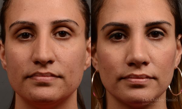 rhinoplasty Nothing demonstrates the skillful craftsmanship that Dr. Oakley Smith accomplishes during his surgeries than a collection of before and after case studies. As one of a hand full of surgeons in North America who limits his practice to only Rhinoplasty surgery, it is obvious that he has mastered his art. There is no question why he is one of the busiest cosmetic nose job surgeons in the country.