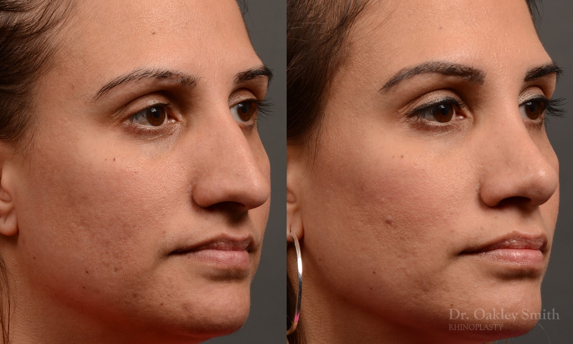 rhinoplasty Nothing demonstrates the skillful craftsmanship that Dr. Oakley Smith accomplishes during his surgeries than a collection of before and after case studies. As one of a hand full of surgeons in North America who limits his practice to only Rhinoplasty surgery, it is obvious that he has mastered his art. There is no question why he is one of the busiest cosmetic nose job surgeons in the country.