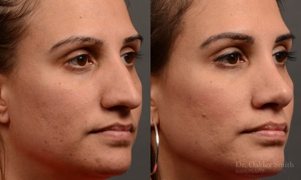 rhinoplasty Nothing demonstrates the skillful craftsmanship that Dr. Oakley Smith accomplishes during his surgeries than a collection of before and after case studies. As one of a hand full of surgeons in North America who limits his practice to only Rhinoplasty surgery, it is obvious that he has mastered his art. There is no question why he is one of the busiest cosmetic nose job surgeons in the country.