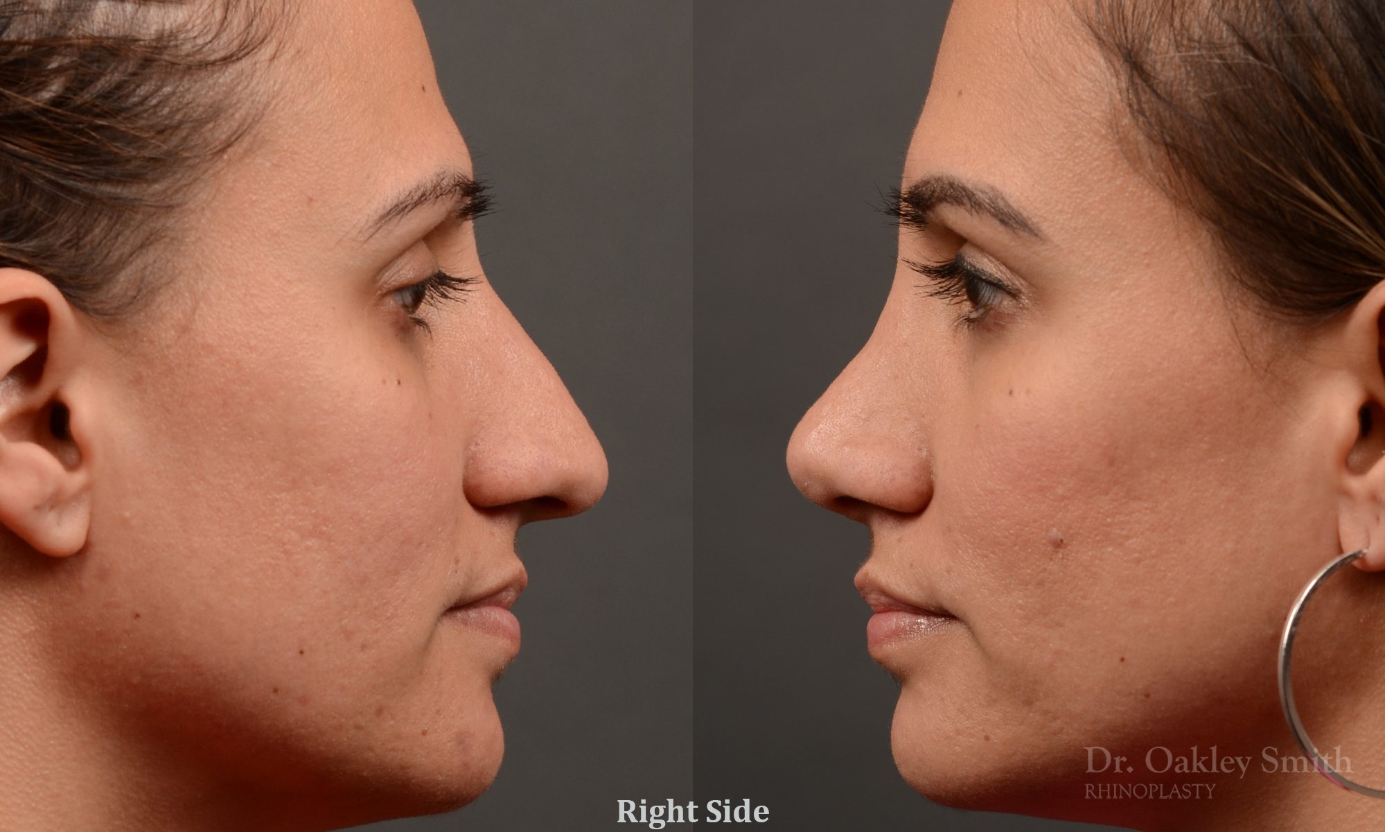 rhinoplasty Nothing demonstrates the skillful craftsmanship that Dr. Oakley Smith accomplishes during his surgeries than a collection of before and after case studies. As one of a hand full of surgeons in North America who limits his practice to only Rhinoplasty surgery, it is obvious that he has mastered his art. There is no question why he is one of the busiest cosmetic nose job surgeons in the country.