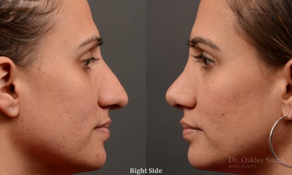 rhinoplasty Nothing demonstrates the skillful craftsmanship that Dr. Oakley Smith accomplishes during his surgeries than a collection of before and after case studies. As one of a hand full of surgeons in North America who limits his practice to only Rhinoplasty surgery, it is obvious that he has mastered his art. There is no question why he is one of the busiest cosmetic nose job surgeons in the country.