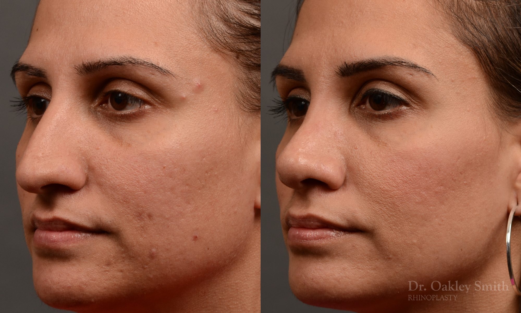 rhinoplasty Nothing demonstrates the skillful craftsmanship that Dr. Oakley Smith accomplishes during his surgeries than a collection of before and after case studies. As one of a hand full of surgeons in North America who limits his practice to only Rhinoplasty surgery, it is obvious that he has mastered his art. There is no question why he is one of the busiest cosmetic nose job surgeons in the country.