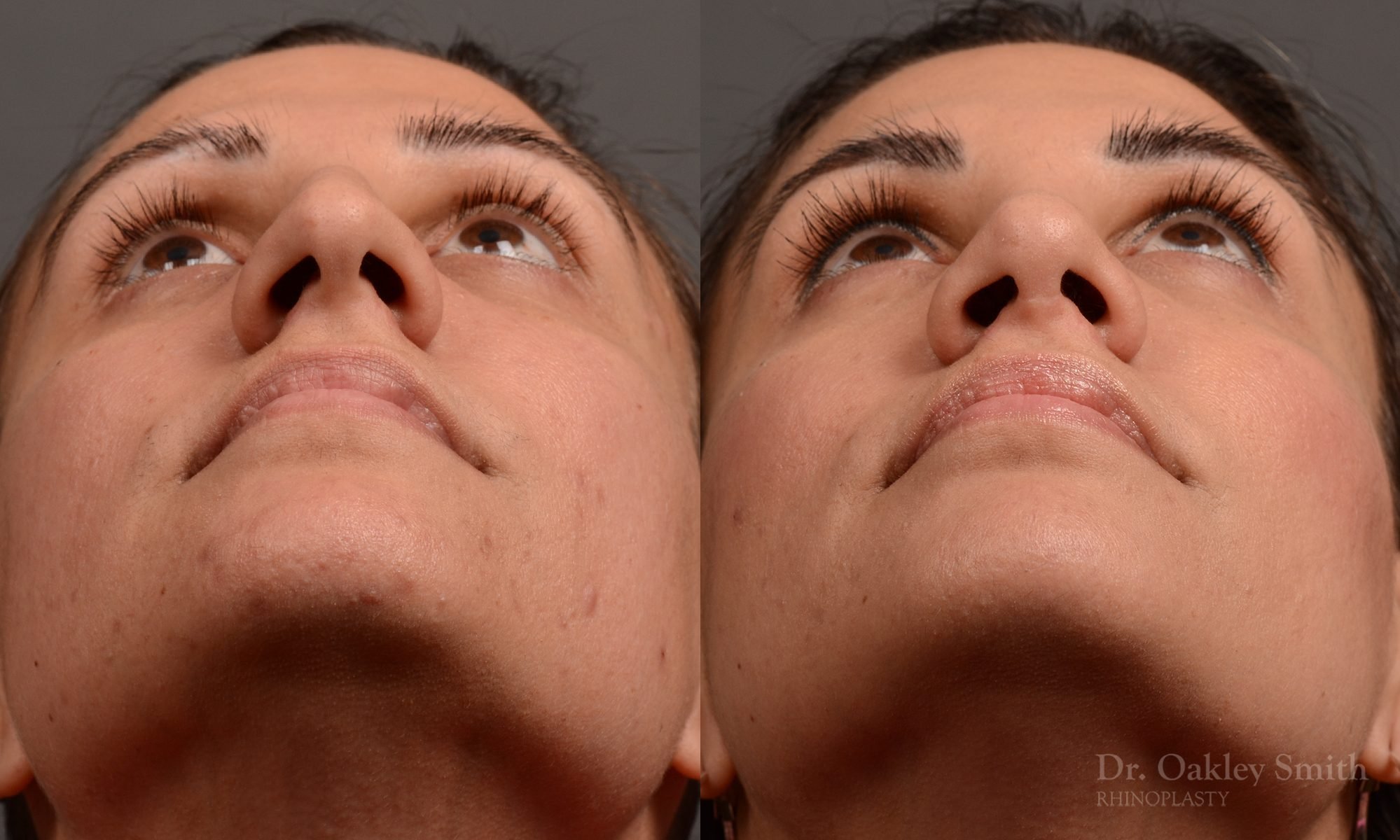 rhinoplasty Nothing demonstrates the skillful craftsmanship that Dr. Oakley Smith accomplishes during his surgeries than a collection of before and after case studies. As one of a hand full of surgeons in North America who limits his practice to only Rhinoplasty surgery, it is obvious that he has mastered his art. There is no question why he is one of the busiest cosmetic nose job surgeons in the country.