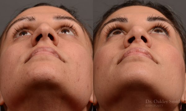 rhinoplasty Nothing demonstrates the skillful craftsmanship that Dr. Oakley Smith accomplishes during his surgeries than a collection of before and after case studies. As one of a hand full of surgeons in North America who limits his practice to only Rhinoplasty surgery, it is obvious that he has mastered his art. There is no question why he is one of the busiest cosmetic nose job surgeons in the country.