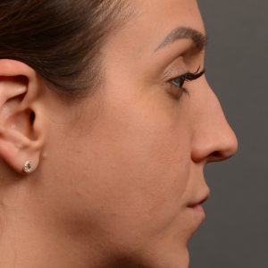 Hump reduction rhinoplasty to create a more feminine nose