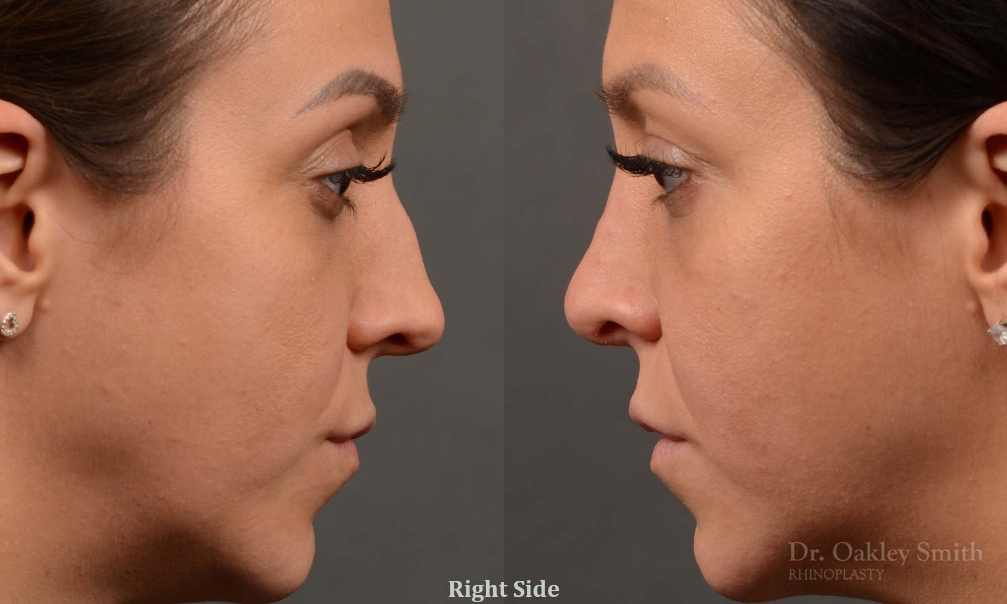 rhinoplasty Nothing demonstrates the skillful craftsmanship that Dr. Oakley Smith accomplishes during his surgeries than a collection of before and after case studies. As one of a hand full of surgeons in North America who limits his practice to only Rhinoplasty surgery, it is obvious that he has mastered his art. There is no question why he is one of the busiest cosmetic nose job surgeons in the country.