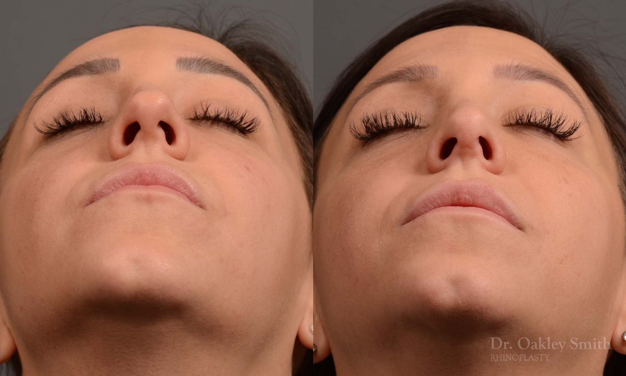 rhinoplasty Nothing demonstrates the skillful craftsmanship that Dr. Oakley Smith accomplishes during his surgeries than a collection of before and after case studies. As one of a hand full of surgeons in North America who limits his practice to only Rhinoplasty surgery, it is obvious that he has mastered his art. There is no question why he is one of the busiest cosmetic nose job surgeons in the country.