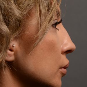 Hump reduction rhinoplasty to create a more feminine nose