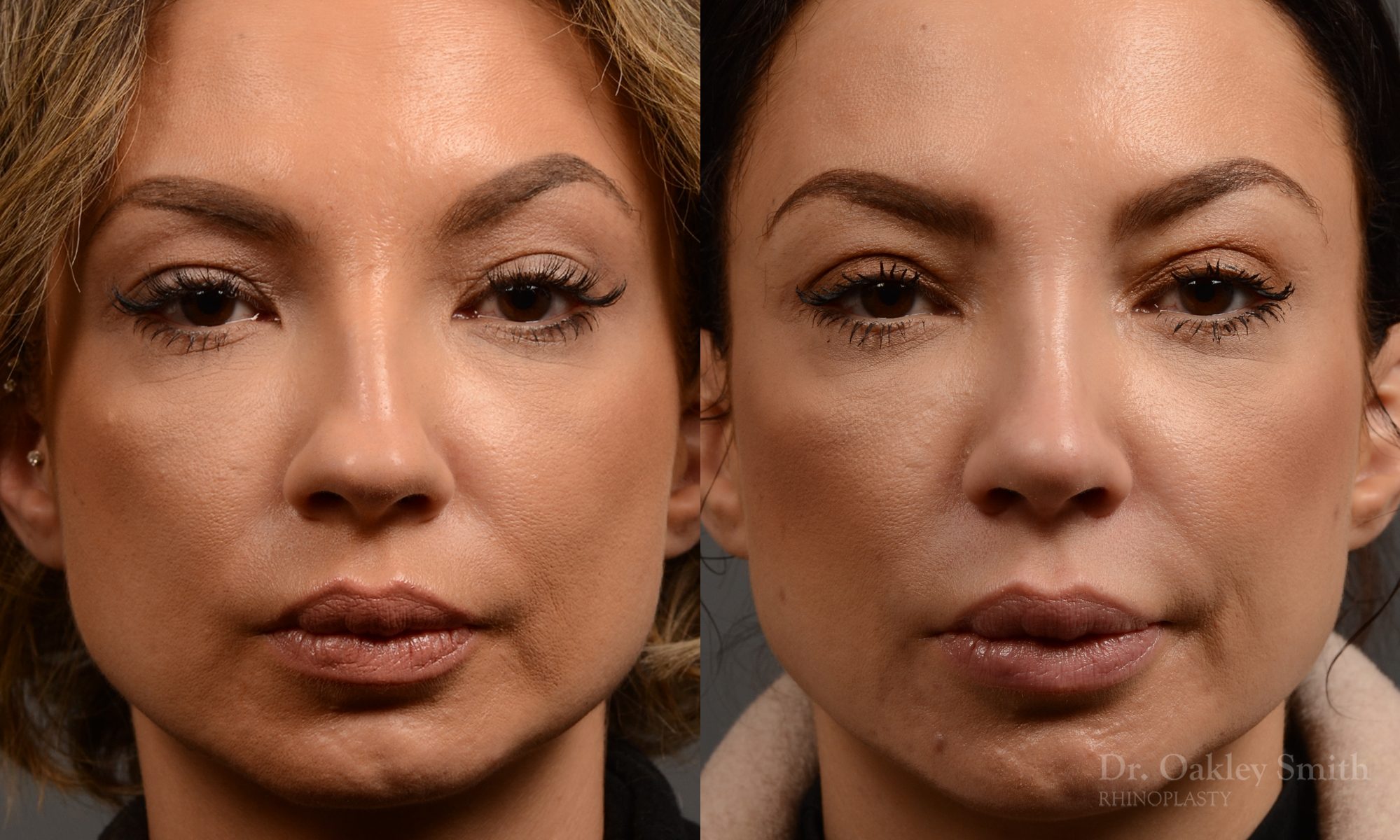 rhinoplasty Nothing demonstrates the skillful craftsmanship that Dr. Oakley Smith accomplishes during his surgeries than a collection of before and after case studies. As one of a hand full of surgeons in North America who limits his practice to only Rhinoplasty surgery, it is obvious that he has mastered his art. There is no question why he is one of the busiest cosmetic nose job surgeons in the country.