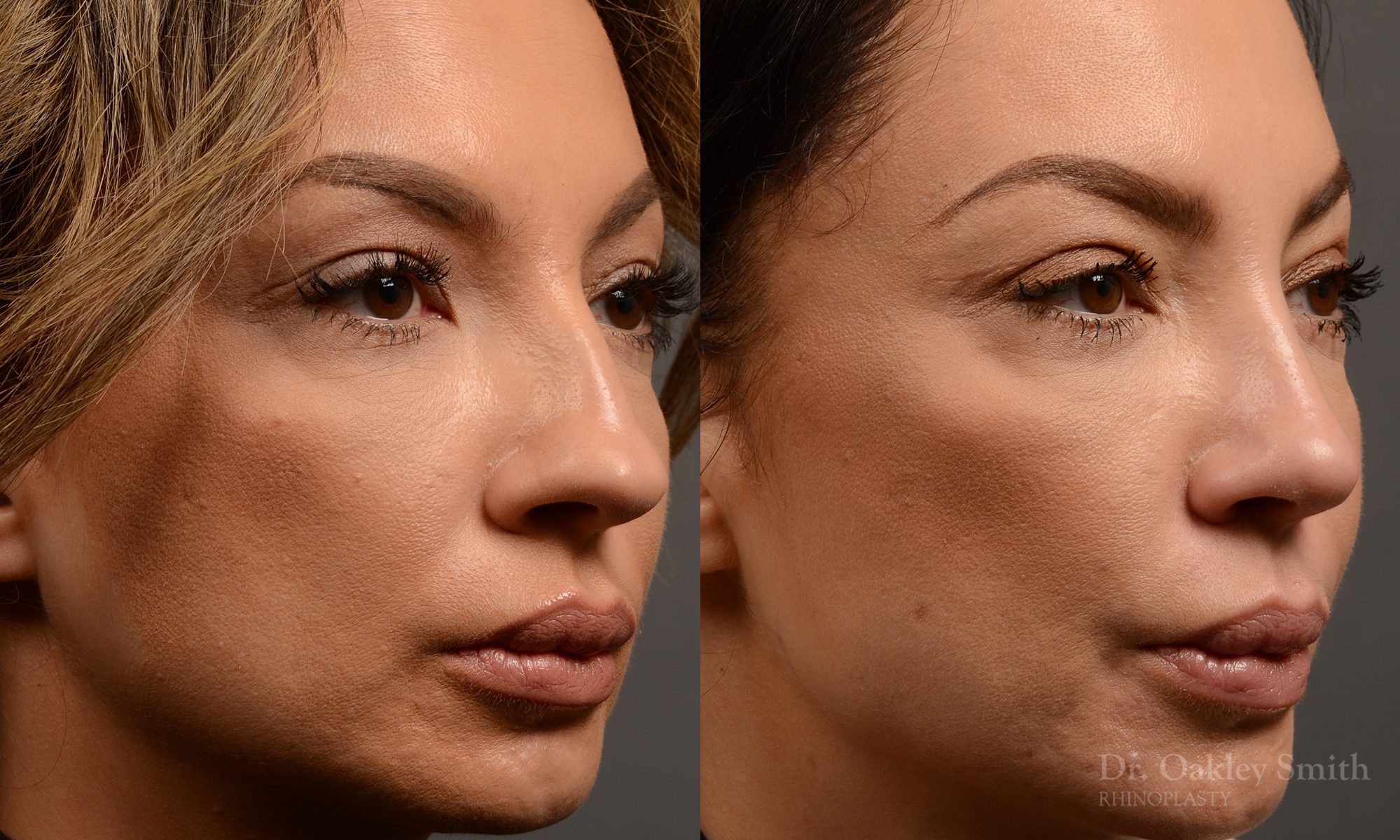rhinoplasty Nothing demonstrates the skillful craftsmanship that Dr. Oakley Smith accomplishes during his surgeries than a collection of before and after case studies. As one of a hand full of surgeons in North America who limits his practice to only Rhinoplasty surgery, it is obvious that he has mastered his art. There is no question why he is one of the busiest cosmetic nose job surgeons in the country.