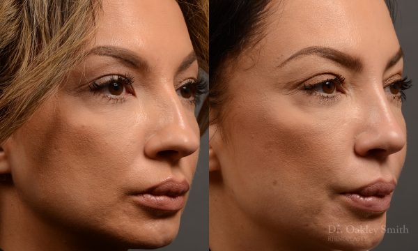 rhinoplasty Nothing demonstrates the skillful craftsmanship that Dr. Oakley Smith accomplishes during his surgeries than a collection of before and after case studies. As one of a hand full of surgeons in North America who limits his practice to only Rhinoplasty surgery, it is obvious that he has mastered his art. There is no question why he is one of the busiest cosmetic nose job surgeons in the country.