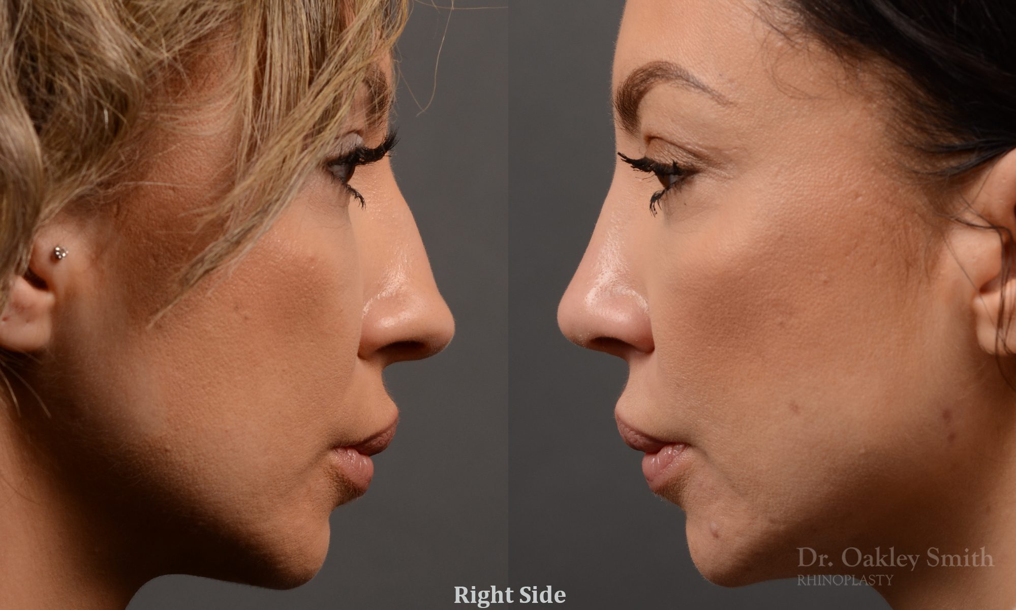 rhinoplasty Nothing demonstrates the skillful craftsmanship that Dr. Oakley Smith accomplishes during his surgeries than a collection of before and after case studies. As one of a hand full of surgeons in North America who limits his practice to only Rhinoplasty surgery, it is obvious that he has mastered his art. There is no question why he is one of the busiest cosmetic nose job surgeons in the country.