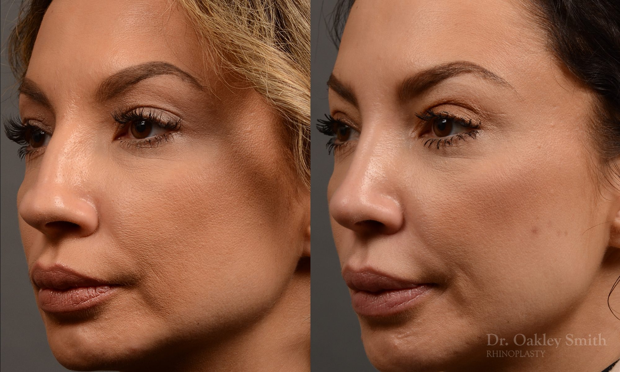 rhinoplasty Nothing demonstrates the skillful craftsmanship that Dr. Oakley Smith accomplishes during his surgeries than a collection of before and after case studies. As one of a hand full of surgeons in North America who limits his practice to only Rhinoplasty surgery, it is obvious that he has mastered his art. There is no question why he is one of the busiest cosmetic nose job surgeons in the country.
