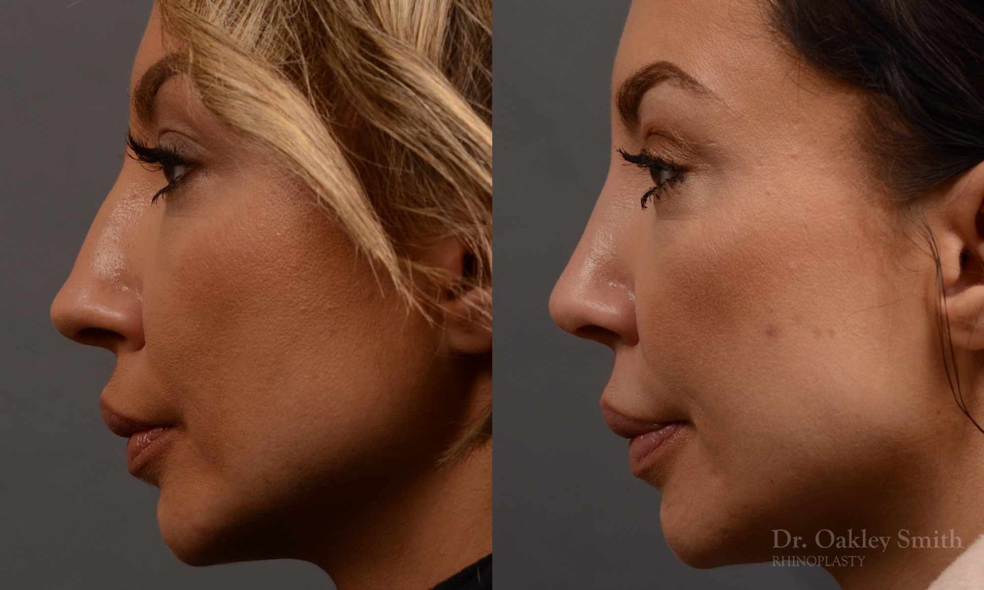 rhinoplasty Nothing demonstrates the skillful craftsmanship that Dr. Oakley Smith accomplishes during his surgeries than a collection of before and after case studies. As one of a hand full of surgeons in North America who limits his practice to only Rhinoplasty surgery, it is obvious that he has mastered his art. There is no question why he is one of the busiest cosmetic nose job surgeons in the country.