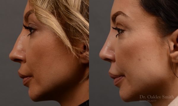 rhinoplasty Nothing demonstrates the skillful craftsmanship that Dr. Oakley Smith accomplishes during his surgeries than a collection of before and after case studies. As one of a hand full of surgeons in North America who limits his practice to only Rhinoplasty surgery, it is obvious that he has mastered his art. There is no question why he is one of the busiest cosmetic nose job surgeons in the country.