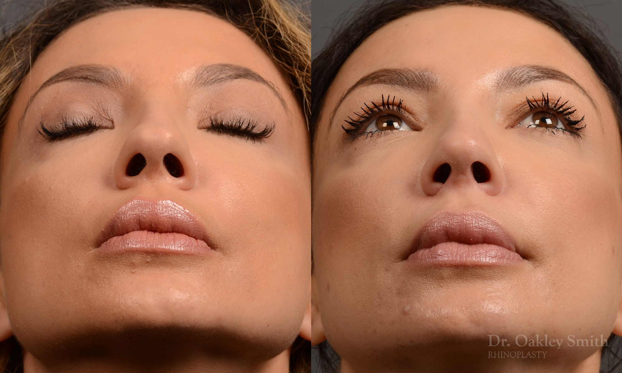 rhinoplasty Nothing demonstrates the skillful craftsmanship that Dr. Oakley Smith accomplishes during his surgeries than a collection of before and after case studies. As one of a hand full of surgeons in North America who limits his practice to only Rhinoplasty surgery, it is obvious that he has mastered his art. There is no question why he is one of the busiest cosmetic nose job surgeons in the country.