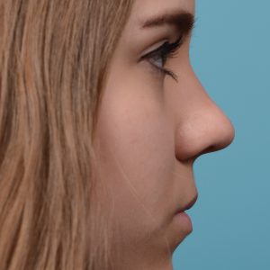 Female nose rhinoplasty remove curvature