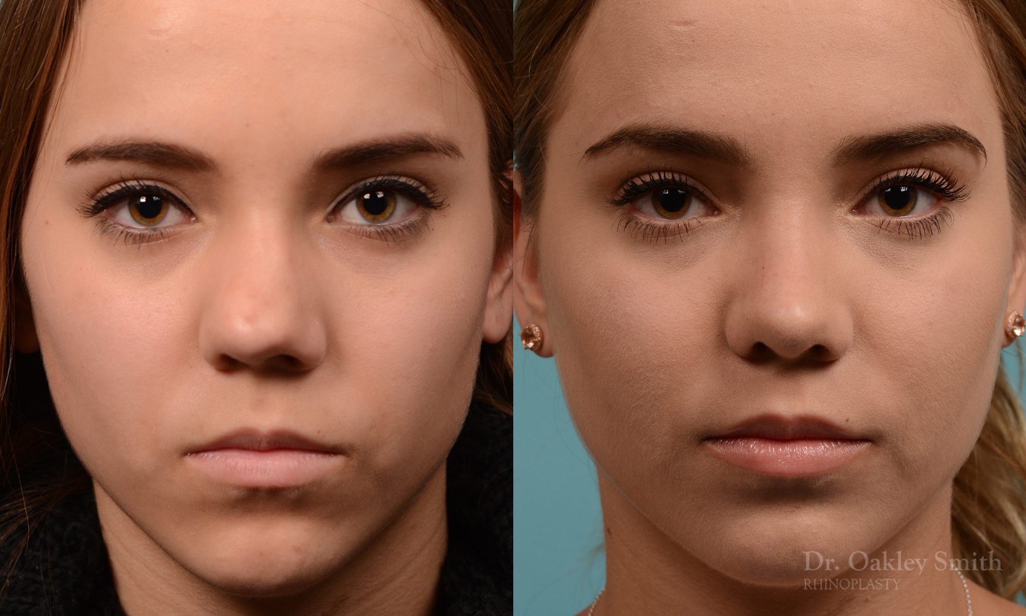 Female nose rhinoplasty remove curvature