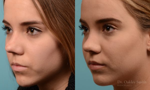 Female nose rhinoplasty remove curvature