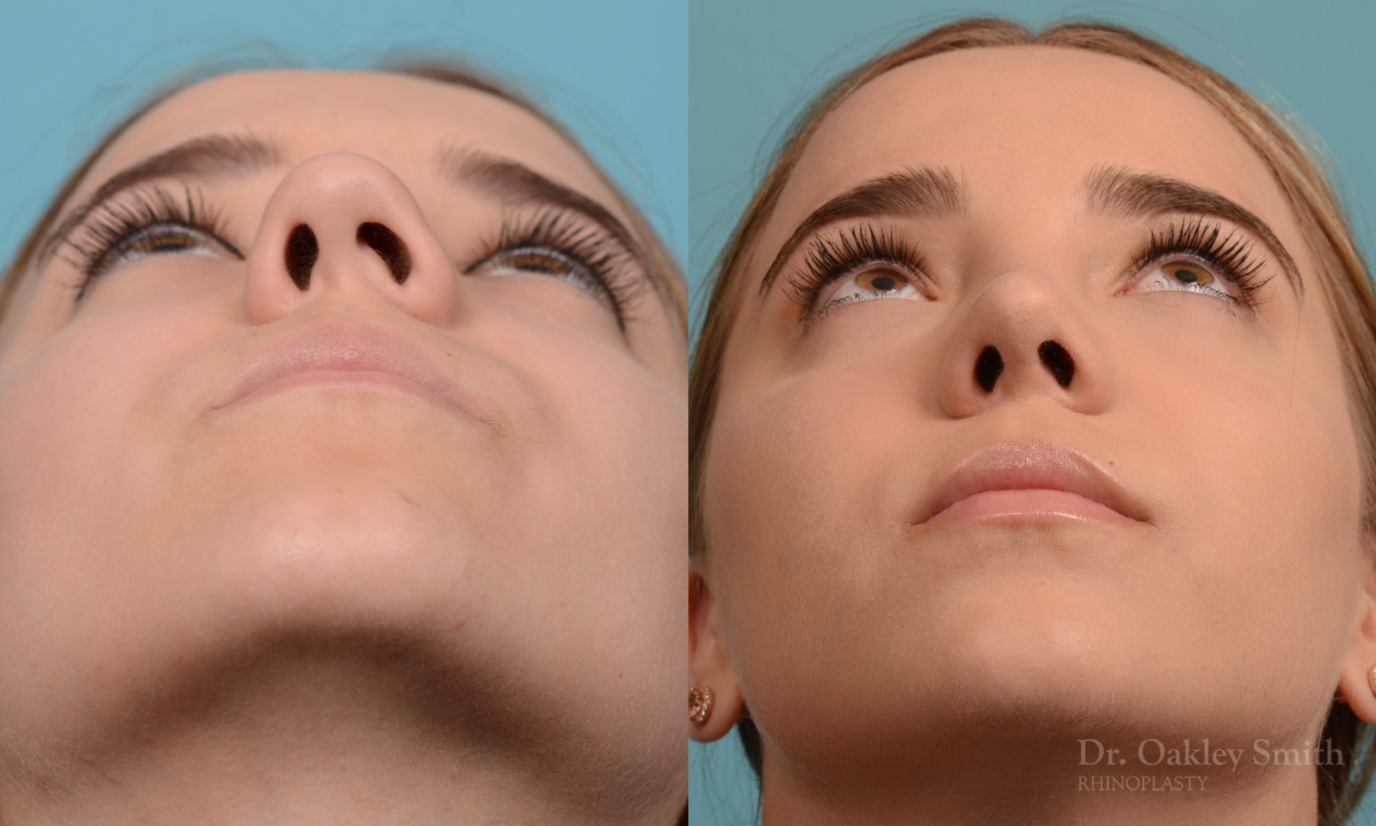 Female nose rhinoplasty remove curvature