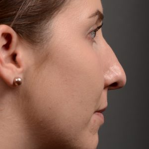 Hump reduction rhinoplasty to create a more feminine nose