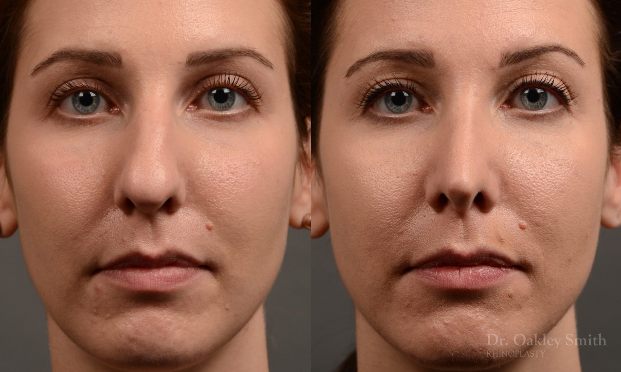 rhinoplasty Nothing demonstrates the skillful craftsmanship that Dr. Oakley Smith accomplishes during his surgeries than a collection of before and after case studies. As one of a hand full of surgeons in North America who limits his practice to only Rhinoplasty surgery, it is obvious that he has mastered his art. There is no question why he is one of the busiest cosmetic nose job surgeons in the country.