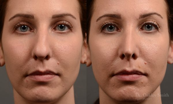 rhinoplasty Nothing demonstrates the skillful craftsmanship that Dr. Oakley Smith accomplishes during his surgeries than a collection of before and after case studies. As one of a hand full of surgeons in North America who limits his practice to only Rhinoplasty surgery, it is obvious that he has mastered his art. There is no question why he is one of the busiest cosmetic nose job surgeons in the country.