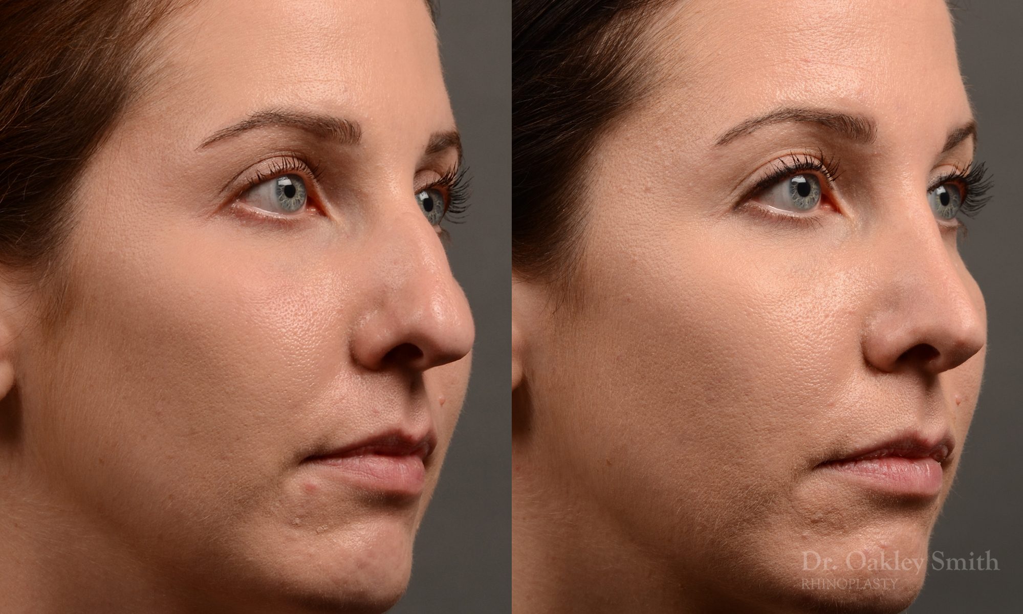 rhinoplasty Nothing demonstrates the skillful craftsmanship that Dr. Oakley Smith accomplishes during his surgeries than a collection of before and after case studies. As one of a hand full of surgeons in North America who limits his practice to only Rhinoplasty surgery, it is obvious that he has mastered his art. There is no question why he is one of the busiest cosmetic nose job surgeons in the country.
