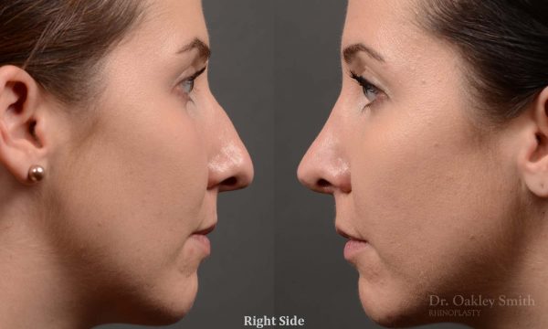 rhinoplasty Nothing demonstrates the skillful craftsmanship that Dr. Oakley Smith accomplishes during his surgeries than a collection of before and after case studies. As one of a hand full of surgeons in North America who limits his practice to only Rhinoplasty surgery, it is obvious that he has mastered his art. There is no question why he is one of the busiest cosmetic nose job surgeons in the country.