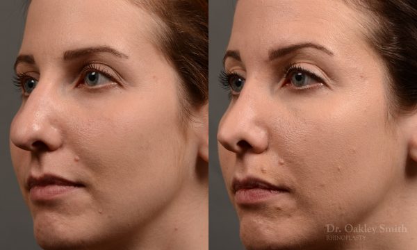 rhinoplasty Nothing demonstrates the skillful craftsmanship that Dr. Oakley Smith accomplishes during his surgeries than a collection of before and after case studies. As one of a hand full of surgeons in North America who limits his practice to only Rhinoplasty surgery, it is obvious that he has mastered his art. There is no question why he is one of the busiest cosmetic nose job surgeons in the country.