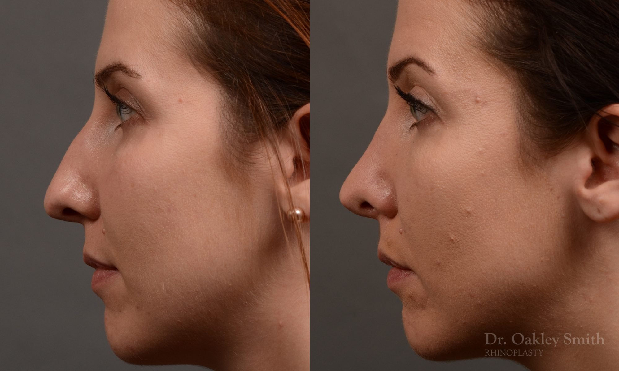 rhinoplasty Nothing demonstrates the skillful craftsmanship that Dr. Oakley Smith accomplishes during his surgeries than a collection of before and after case studies. As one of a hand full of surgeons in North America who limits his practice to only Rhinoplasty surgery, it is obvious that he has mastered his art. There is no question why he is one of the busiest cosmetic nose job surgeons in the country.