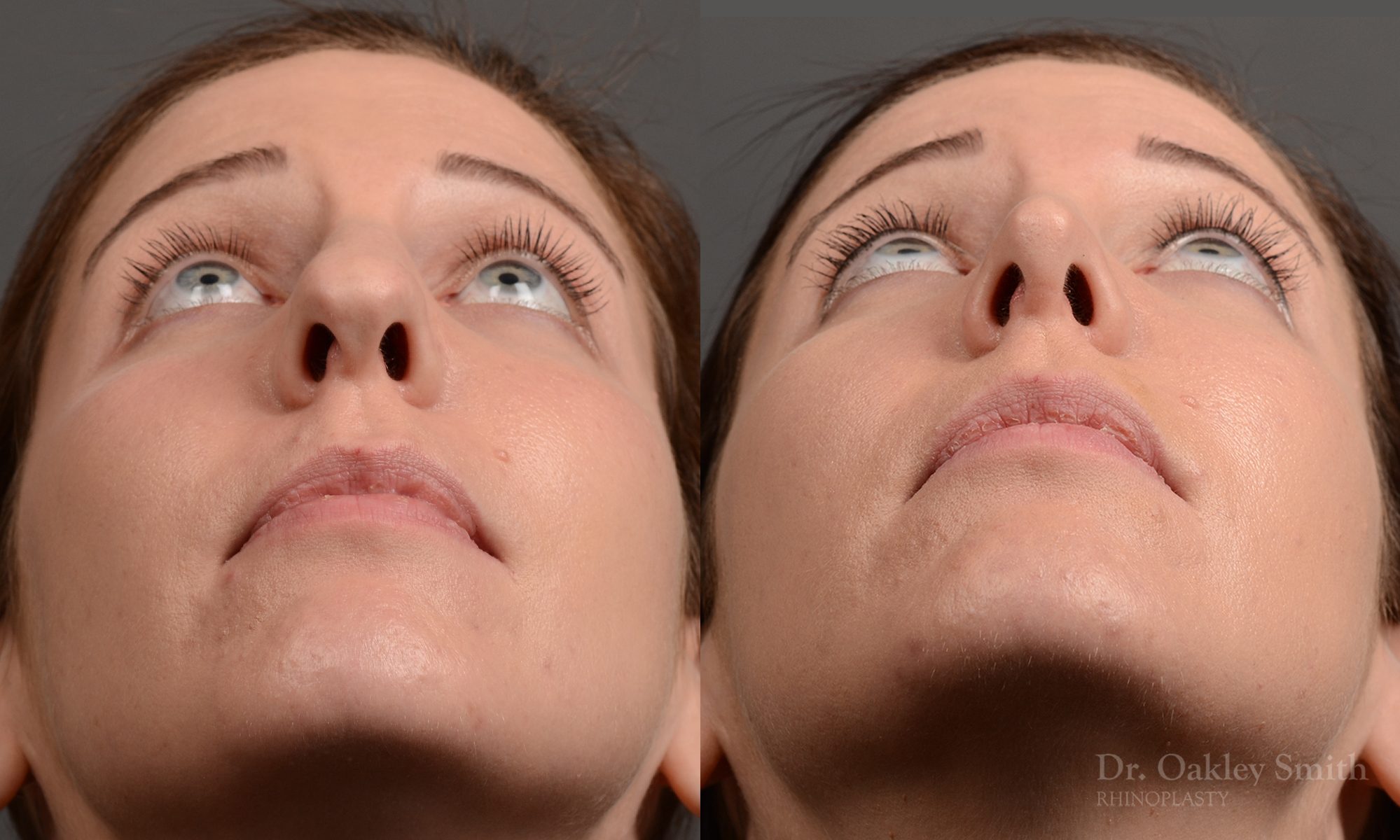 rhinoplasty Nothing demonstrates the skillful craftsmanship that Dr. Oakley Smith accomplishes during his surgeries than a collection of before and after case studies. As one of a hand full of surgeons in North America who limits his practice to only Rhinoplasty surgery, it is obvious that he has mastered his art. There is no question why he is one of the busiest cosmetic nose job surgeons in the country.