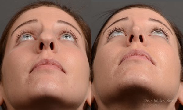 rhinoplasty Nothing demonstrates the skillful craftsmanship that Dr. Oakley Smith accomplishes during his surgeries than a collection of before and after case studies. As one of a hand full of surgeons in North America who limits his practice to only Rhinoplasty surgery, it is obvious that he has mastered his art. There is no question why he is one of the busiest cosmetic nose job surgeons in the country.