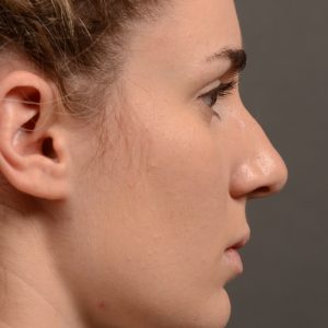 Hump reduction rhinoplasty to create a more feminine nose