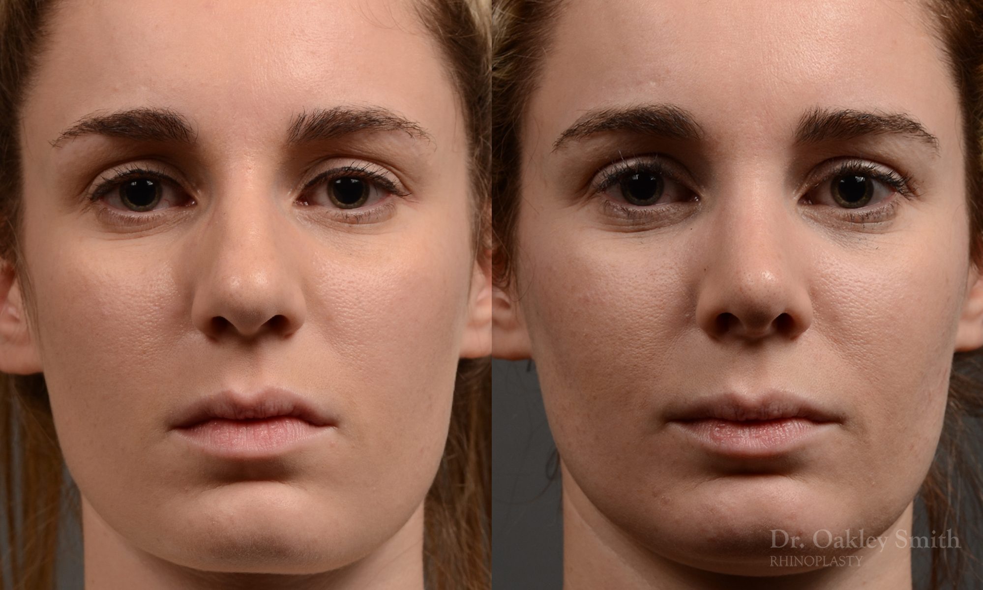 rhinoplasty Nothing demonstrates the skillful craftsmanship that Dr. Oakley Smith accomplishes during his surgeries than a collection of before and after case studies. As one of a hand full of surgeons in North America who limits his practice to only Rhinoplasty surgery, it is obvious that he has mastered his art. There is no question why he is one of the busiest cosmetic nose job surgeons in the country.