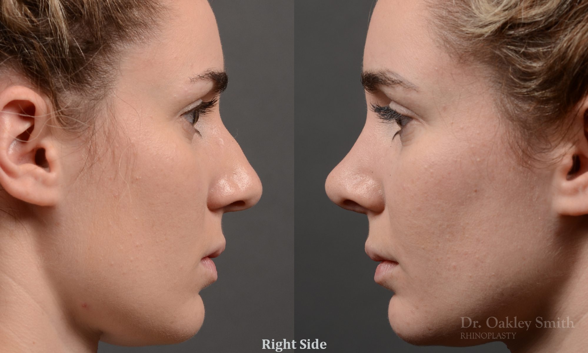 rhinoplasty Nothing demonstrates the skillful craftsmanship that Dr. Oakley Smith accomplishes during his surgeries than a collection of before and after case studies. As one of a hand full of surgeons in North America who limits his practice to only Rhinoplasty surgery, it is obvious that he has mastered his art. There is no question why he is one of the busiest cosmetic nose job surgeons in the country.