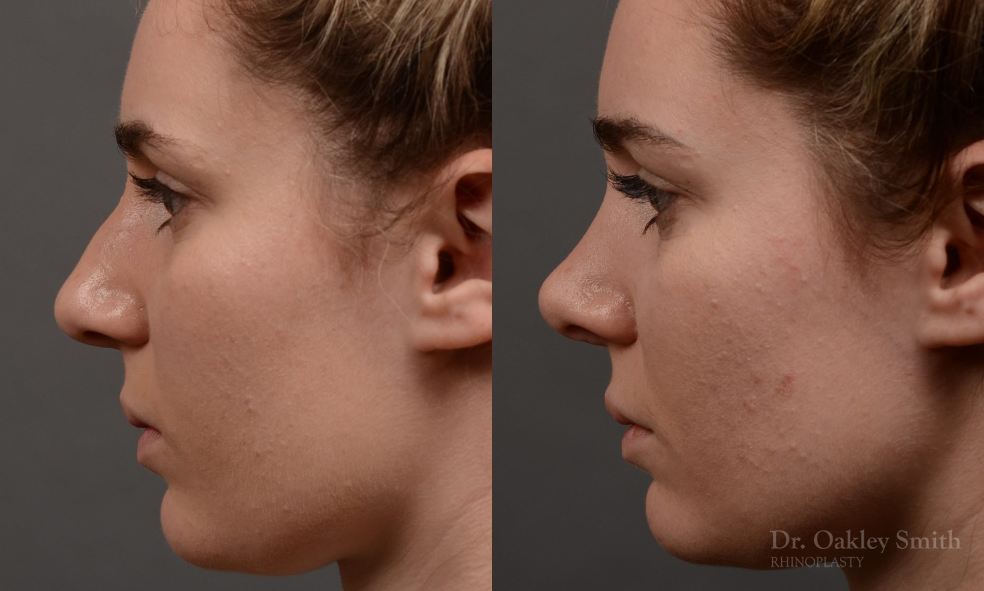 rhinoplasty Nothing demonstrates the skillful craftsmanship that Dr. Oakley Smith accomplishes during his surgeries than a collection of before and after case studies. As one of a hand full of surgeons in North America who limits his practice to only Rhinoplasty surgery, it is obvious that he has mastered his art. There is no question why he is one of the busiest cosmetic nose job surgeons in the country.