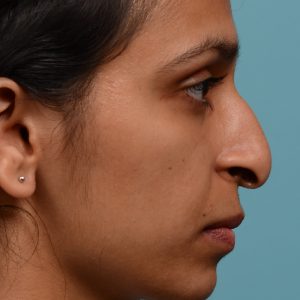 female hook nose reduction rhinoplasty
