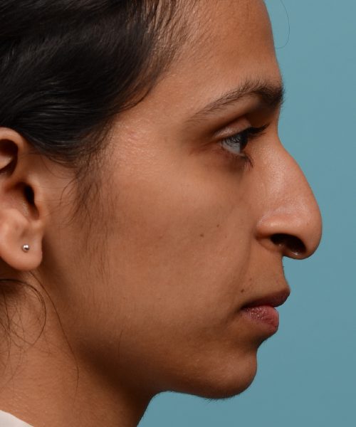 female hook nose reduction rhinoplasty