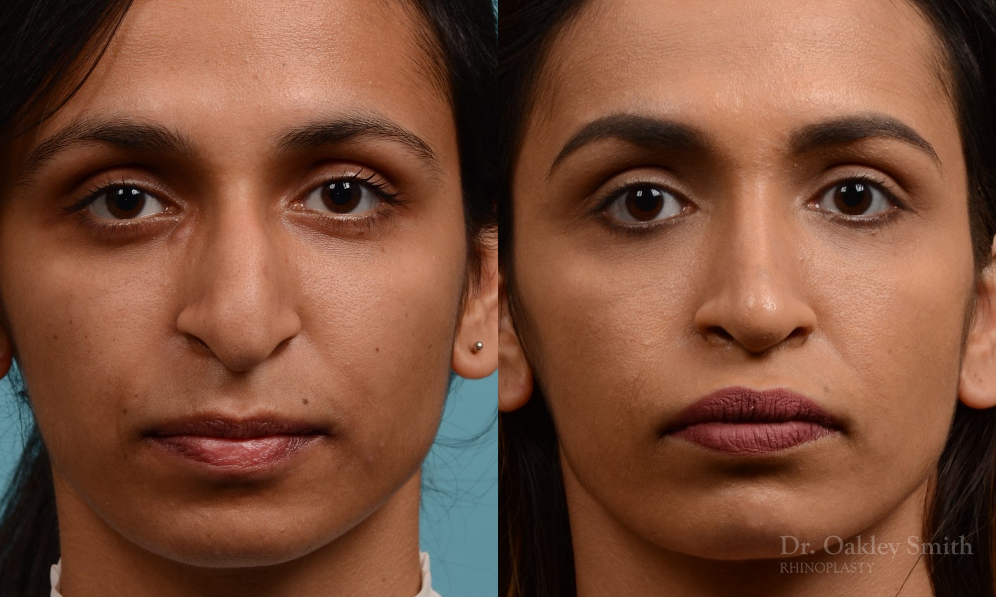rhinoplasty Nothing demonstrates the skillful craftsmanship that Dr. Oakley Smith accomplishes during his surgeries than a collection of before and after case studies. As one of a hand full of surgeons in North America who limits his practice to only Rhinoplasty surgery, it is obvious that he has mastered his art. There is no question why he is one of the busiest cosmetic nose job surgeons in the country.