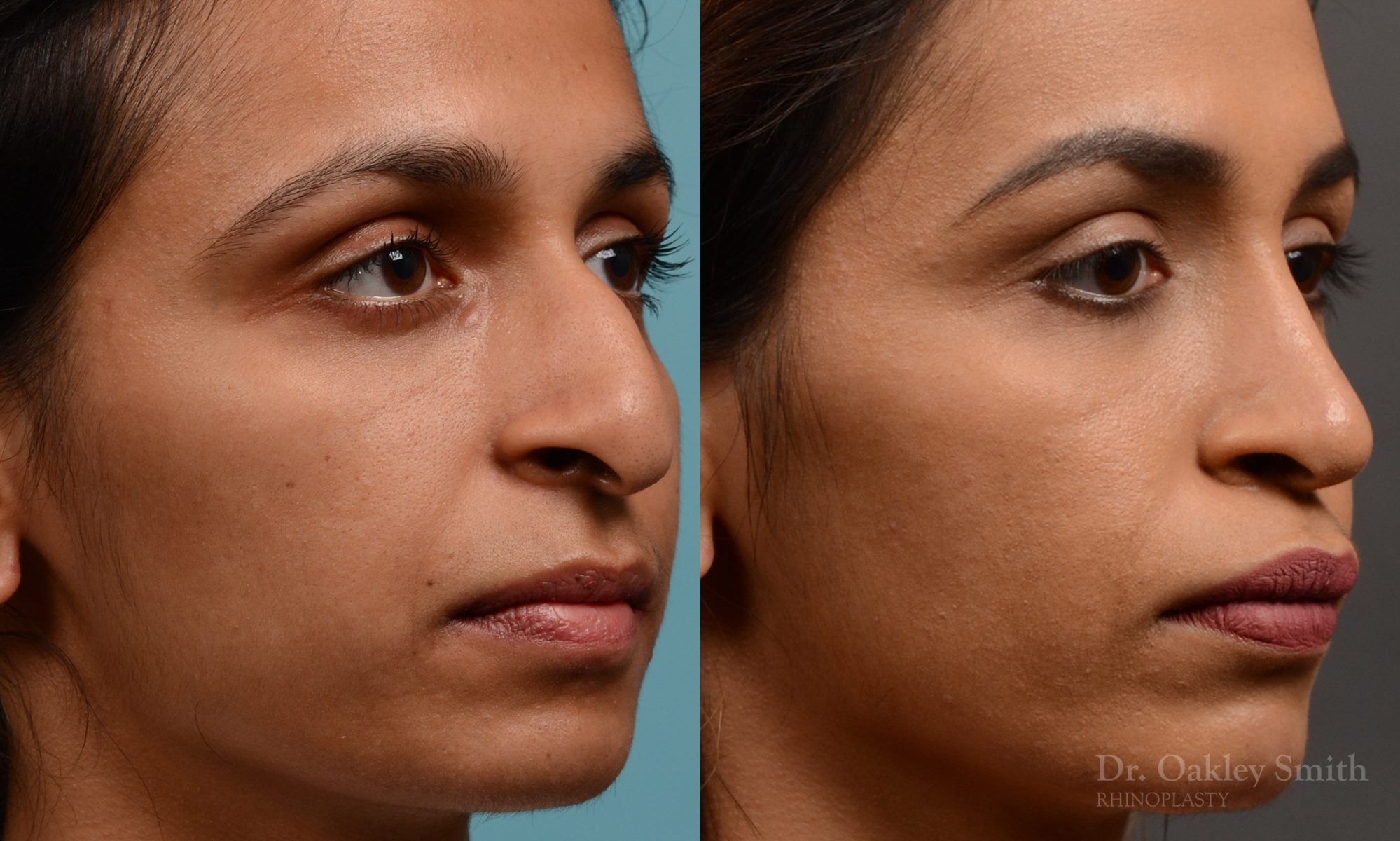 rhinoplasty Nothing demonstrates the skillful craftsmanship that Dr. Oakley Smith accomplishes during his surgeries than a collection of before and after case studies. As one of a hand full of surgeons in North America who limits his practice to only Rhinoplasty surgery, it is obvious that he has mastered his art. There is no question why he is one of the busiest cosmetic nose job surgeons in the country.