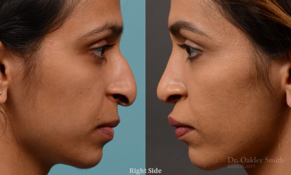 rhinoplasty Nothing demonstrates the skillful craftsmanship that Dr. Oakley Smith accomplishes during his surgeries than a collection of before and after case studies. As one of a hand full of surgeons in North America who limits his practice to only Rhinoplasty surgery, it is obvious that he has mastered his art. There is no question why he is one of the busiest cosmetic nose job surgeons in the country.
